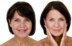 Face lift