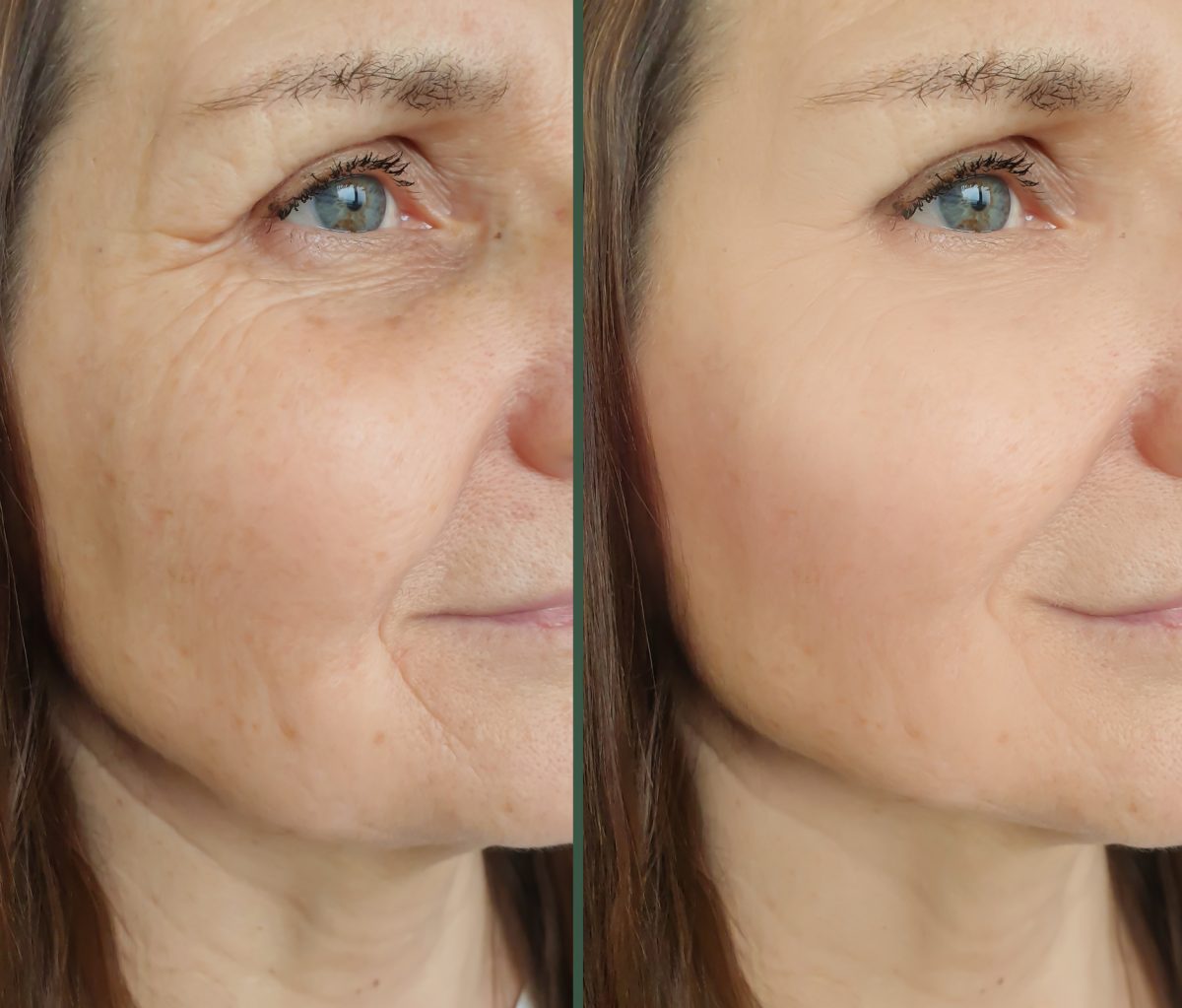 Fine lines before/after