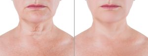 Neck lift: all of your questions answered 2 Neck lift before and after
