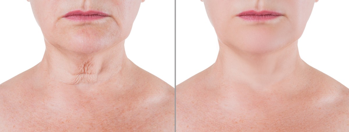 Neck lift: all of your questions answered 1 Neck lift before and after