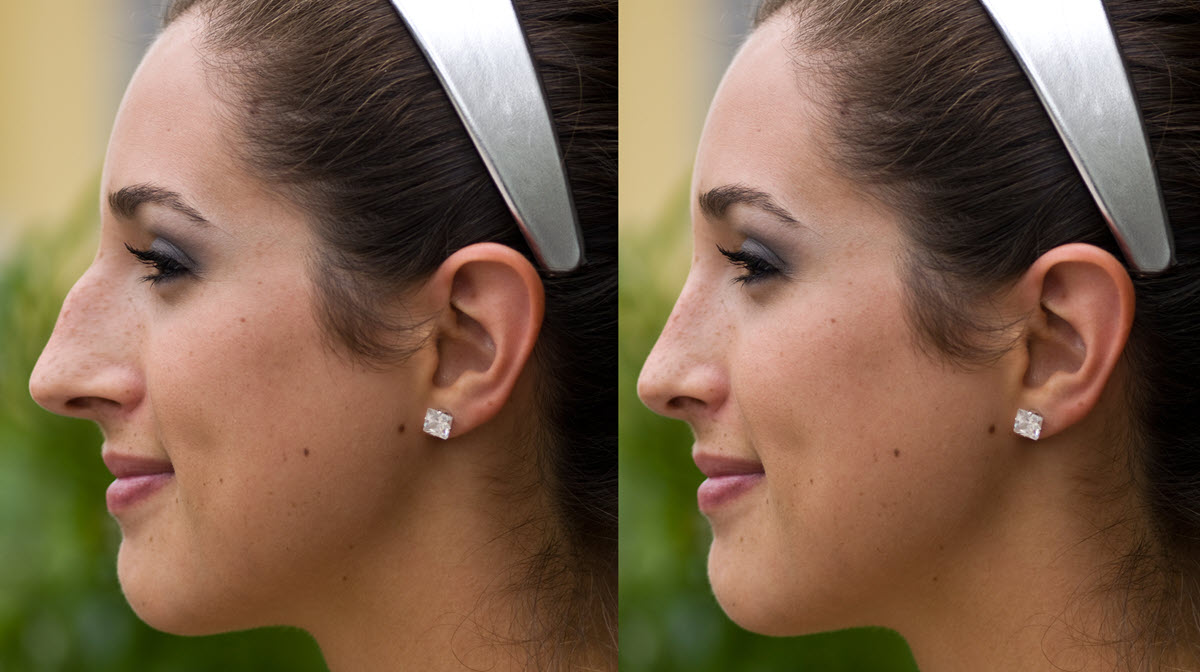 Rhinoplasty before after